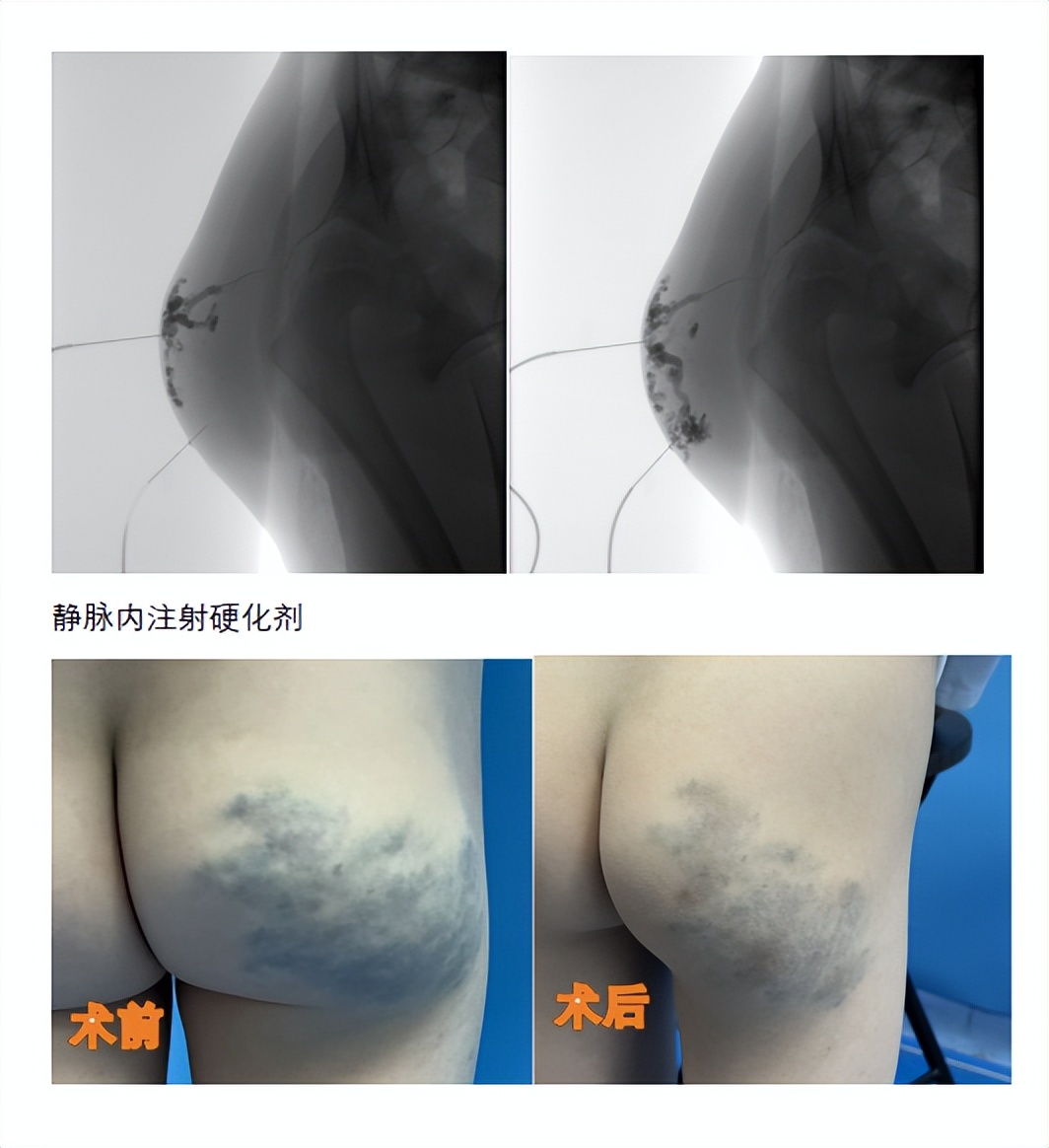 臀部静脉畸形介入治疗病例
