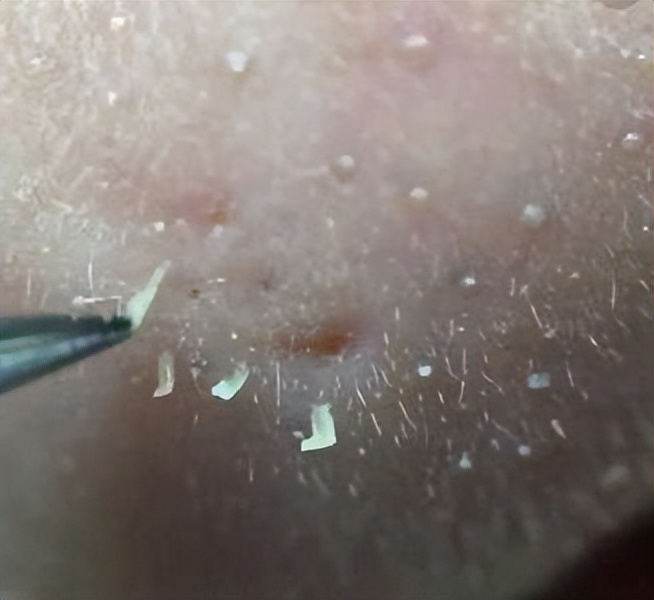 上完粉底液鼻子上有白点,涂粉底液后毛孔有白点点