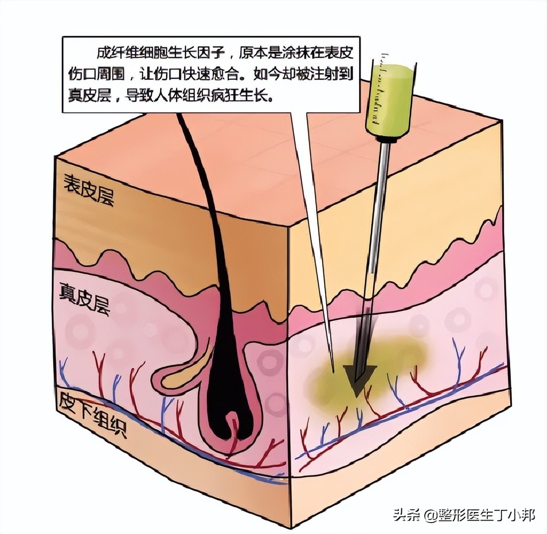 注射生长因子丰下巴导致下巴变形，怎么办？