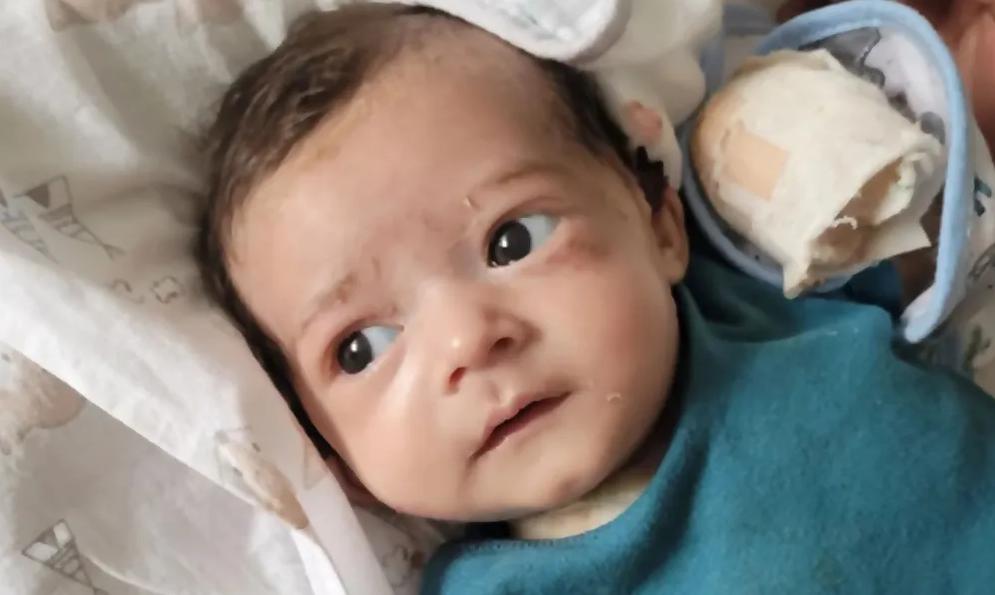 巴西小男孩患罕见病,巴西小孩患罕见病