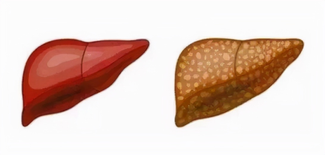 肝硬化病因一分钟短视频,论述肝硬化的临床病理