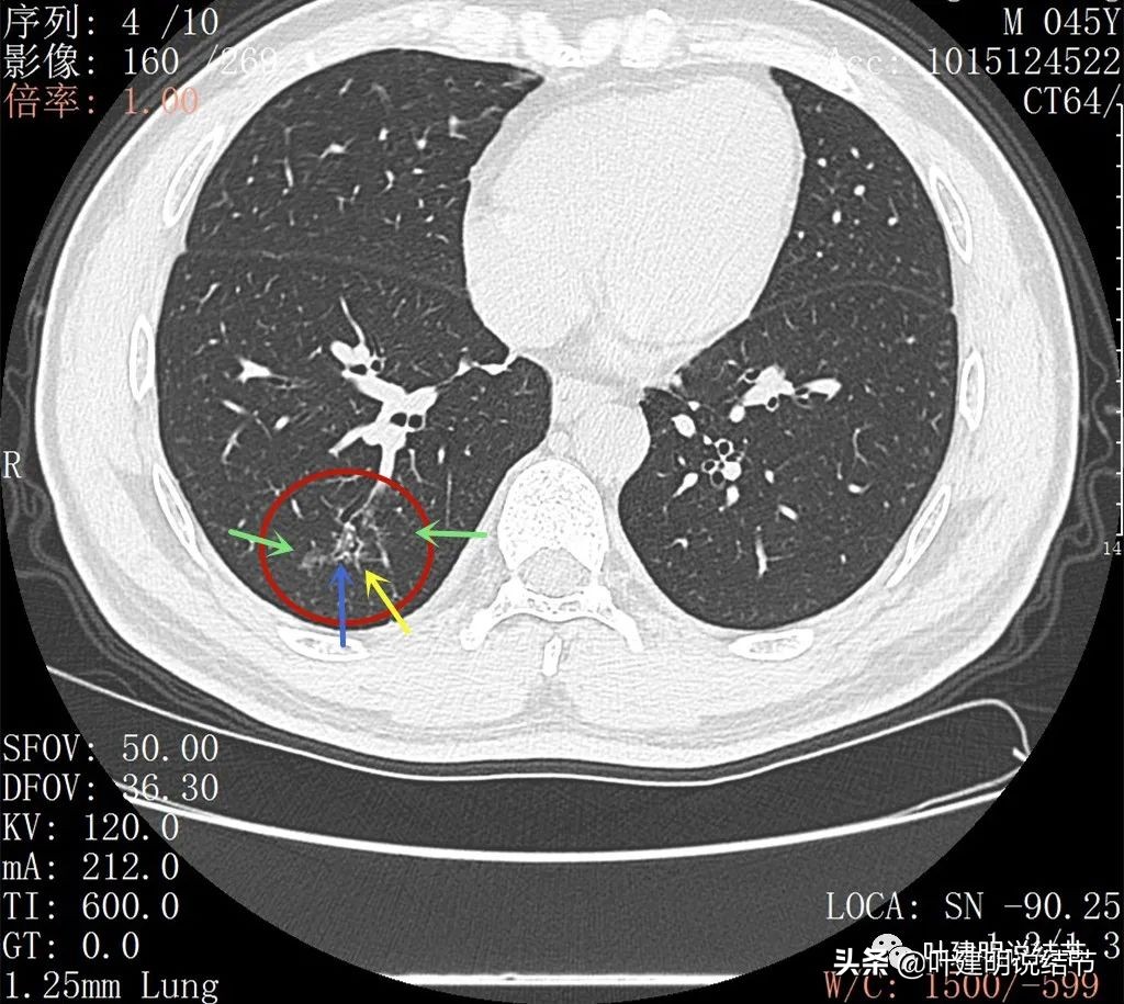 肺蜂窝状改变是肺癌吗,肺部陈旧灶与肿瘤怎么确诊