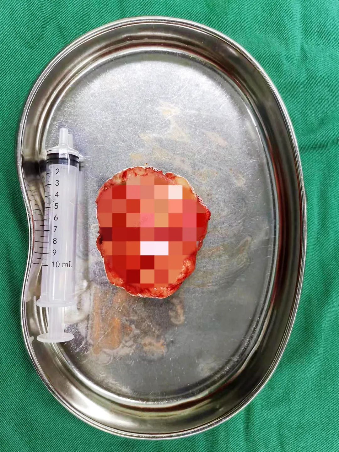 胸小会得乳腺纤维瘤吗,乳房大小跟乳腺纤维瘤有关系吗