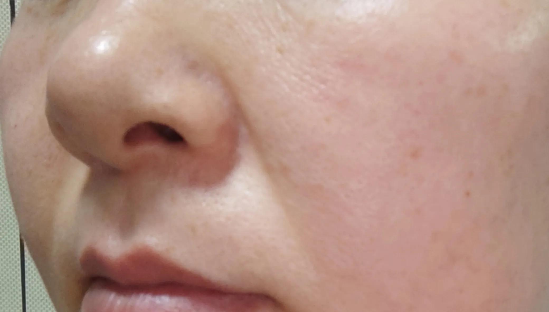 毛孔粗大形成坑怎么办,老化型毛孔粗大形成原因