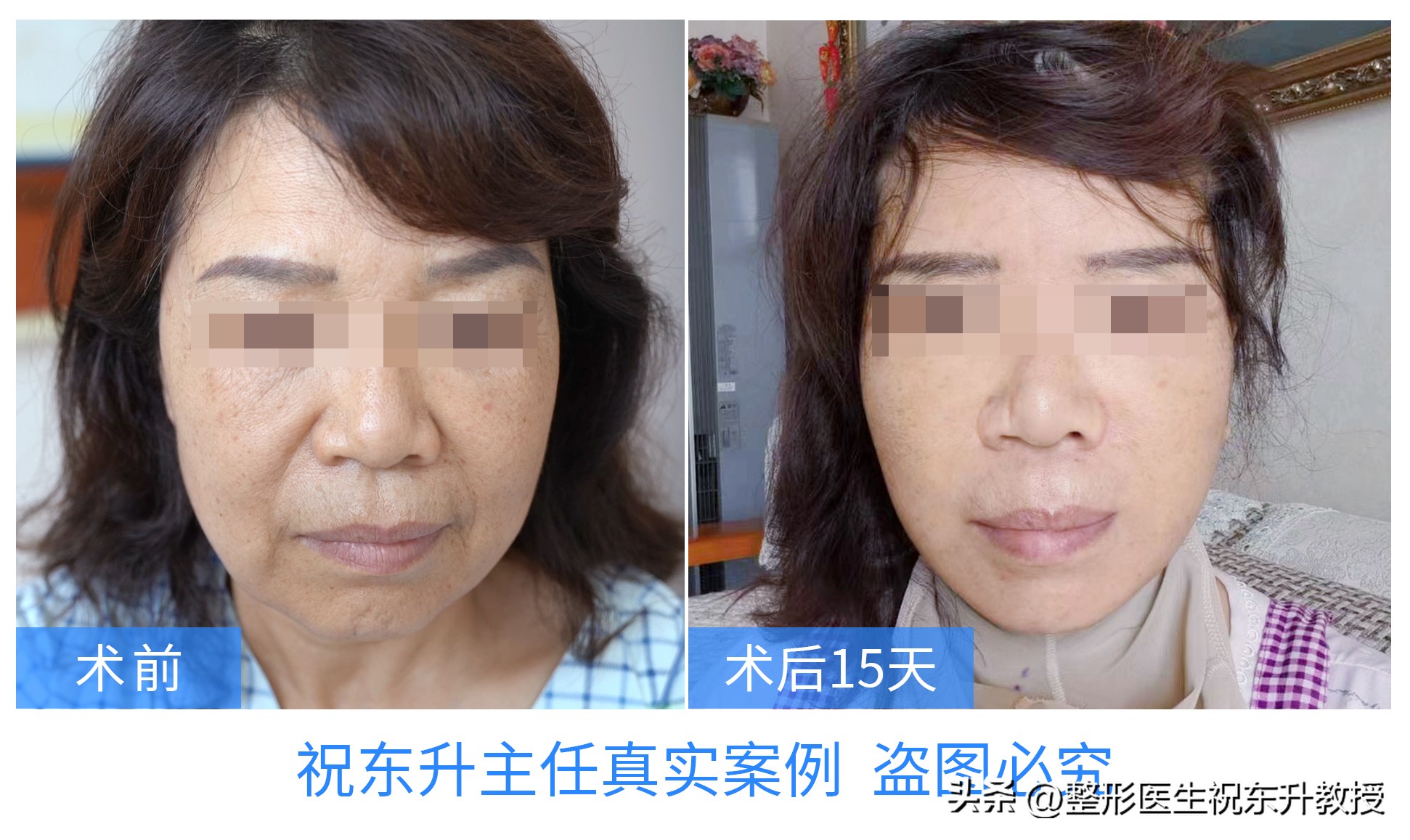 做拉皮手术的朋友感言,拉皮手术大实话听完你还敢做吗