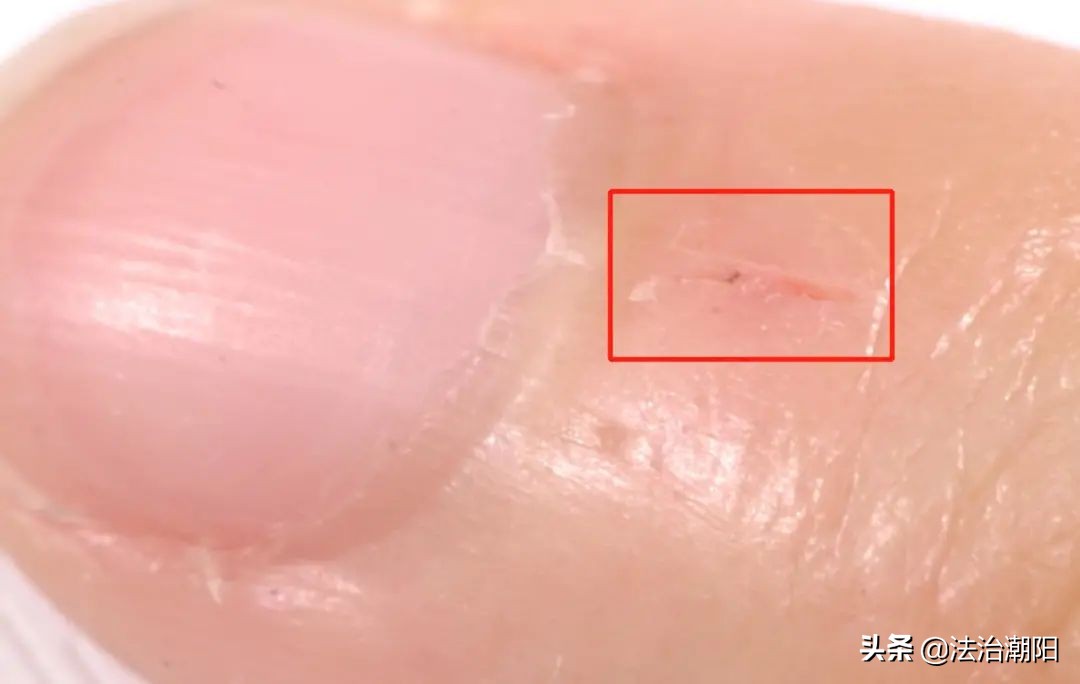 手指长倒刺缺乏哪种维生素,宝宝手指倒刺是缺什么维生素