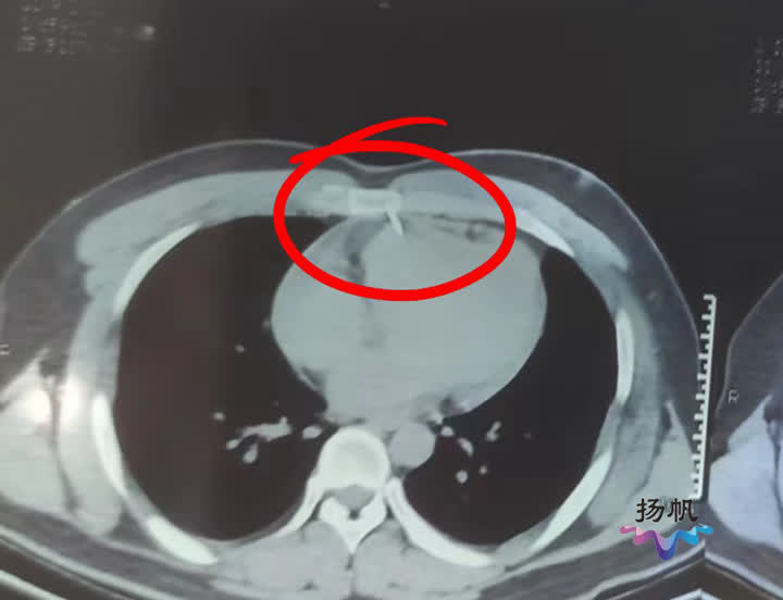 扎心了！气钉击中小伙心脏医生补心救命