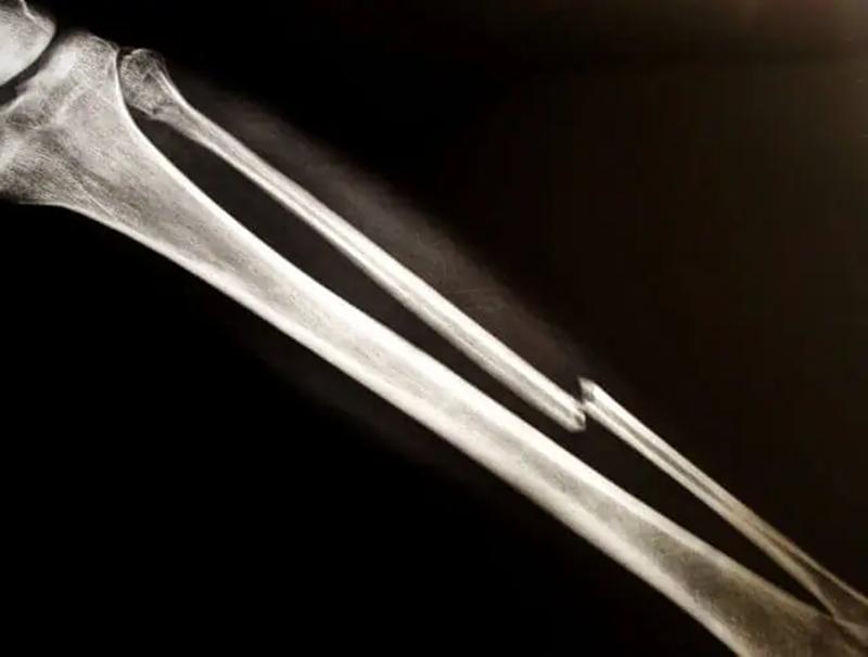 骨折后吸烟影响愈合么,吸烟对骨折愈合有多大影响