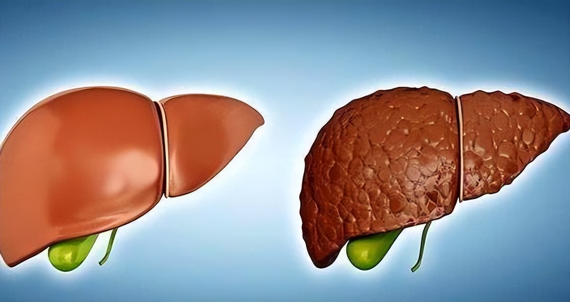 肝脏变硬了该怎么办，或要调理饮食，6种食物推荐给你