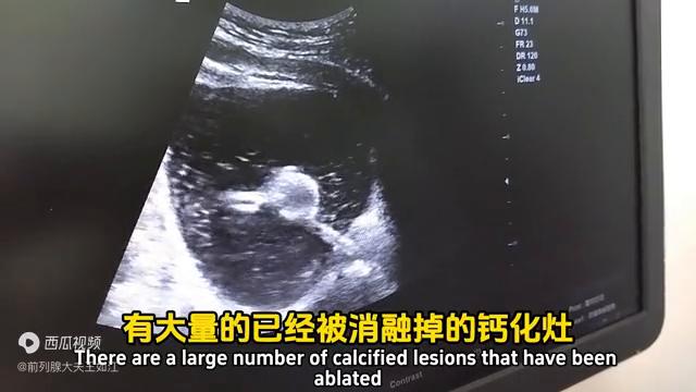 孔院长解读：什么是尿道疏通扩张术？配合前列腺钙化消融术...