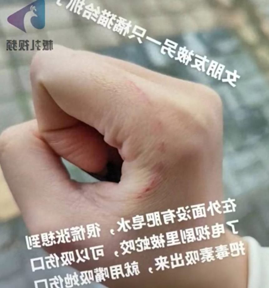 男孩模仿电视节目,吮吸女友的伤口。确诊为3级暴露