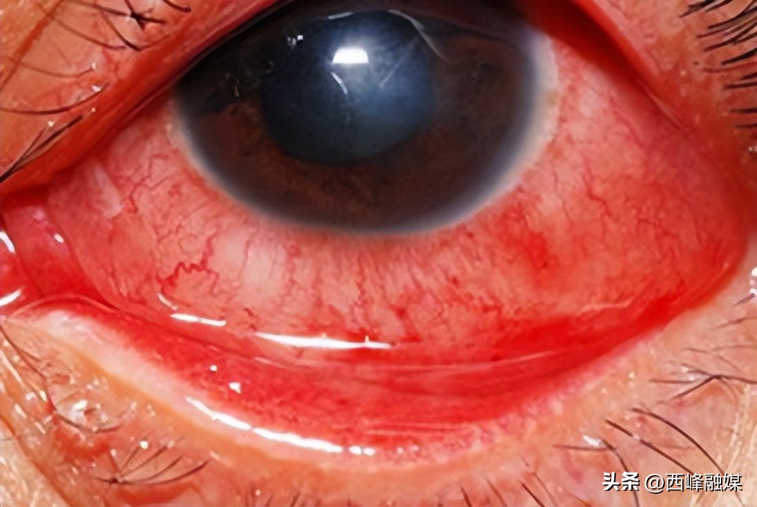 眼科发炎症状,眼睛疼是阳性的前期症状吗