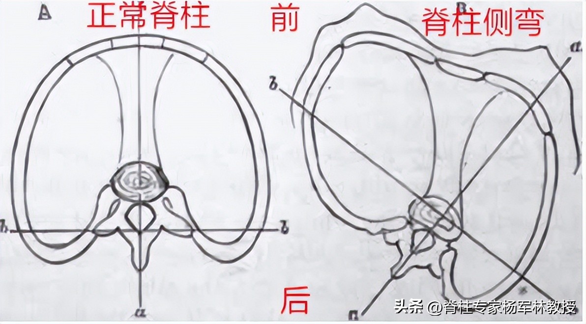 脊柱侧弯10度会出现剃刀背吗,剃刀背会误诊吗