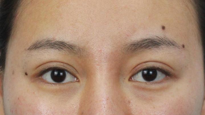 修复假宽深双眼皮最好的医院,双眼皮做宽了显老怎么补救