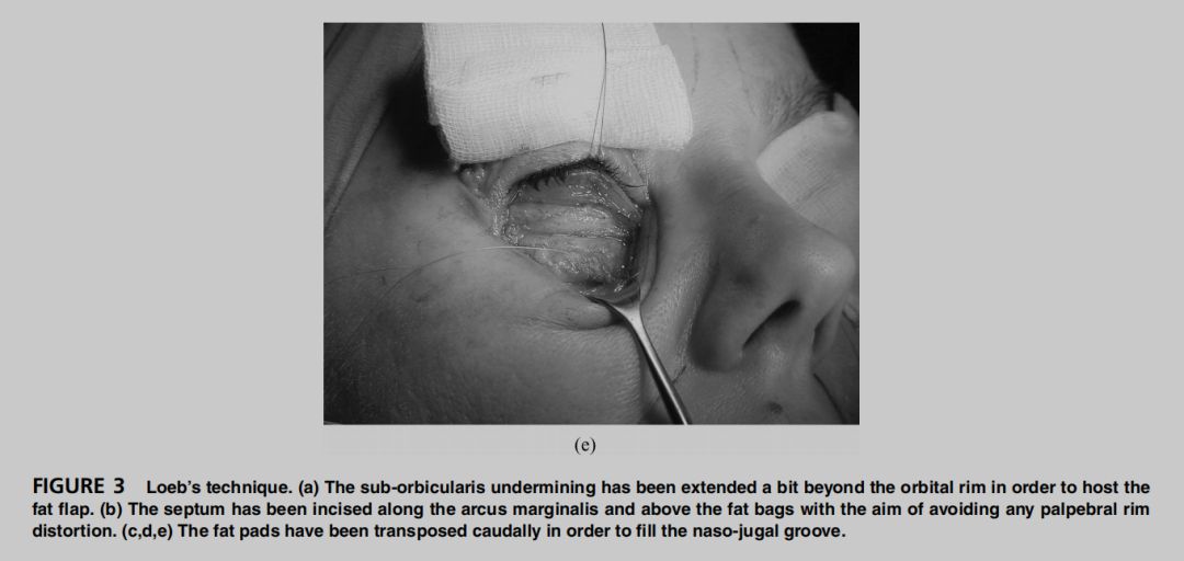印第安纹解剖学,印第安纹分型对策
