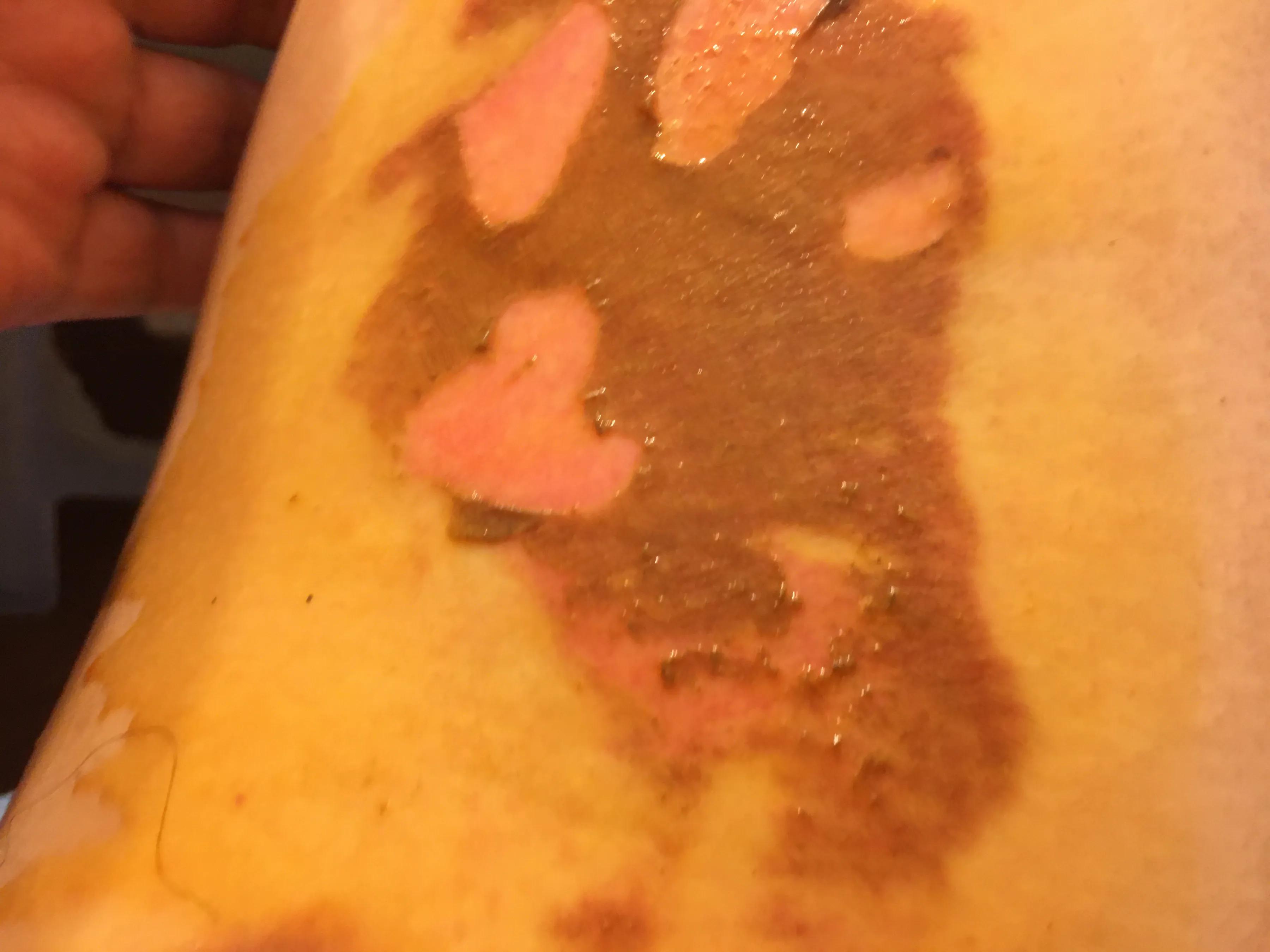 烫伤后的正确处理方法就这五个字,知识分享烫伤后的正确处理方式