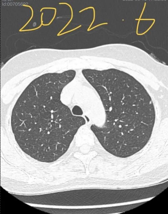 九个月内出现6mm磨玻璃结节,6mm的磨玻璃结节微浸润