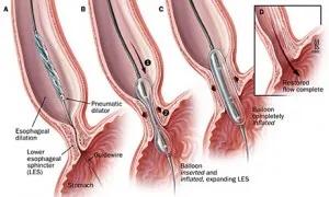 治疗胃食管反流中药有哪些,ppi治疗胃食管反流疗程