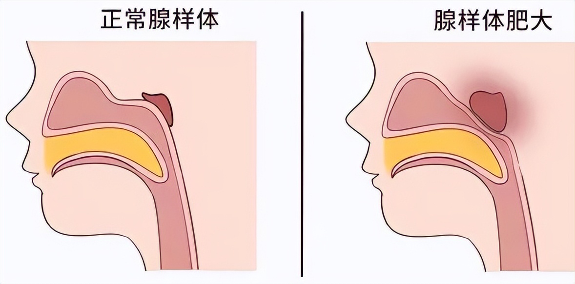 没感冒鼻子不通气是什么原因,鼻子不通气冒火什么原因引起