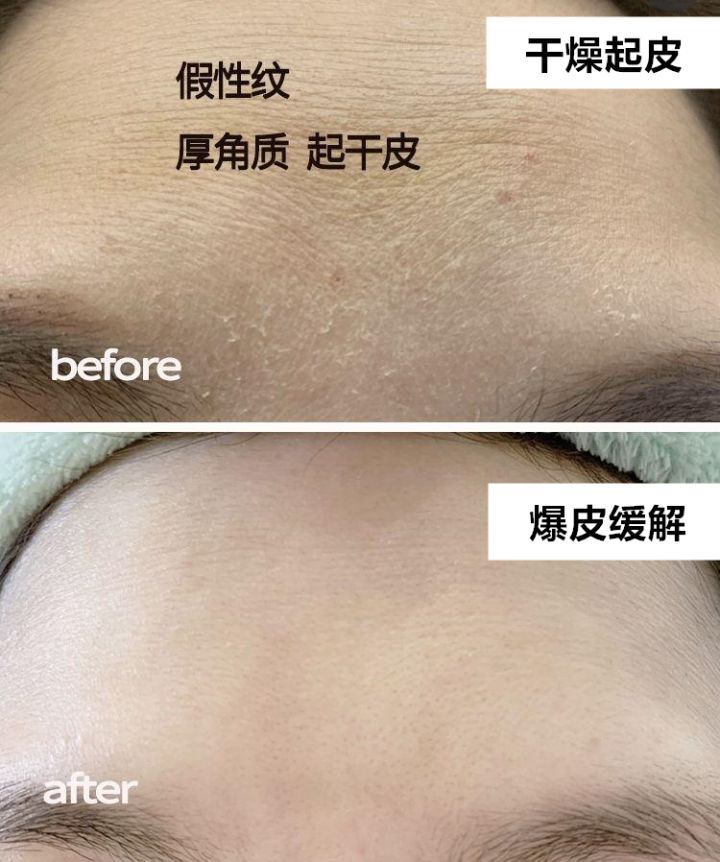 脸上起皮了是怎么回事,脸上起皮是什么原因怎么办