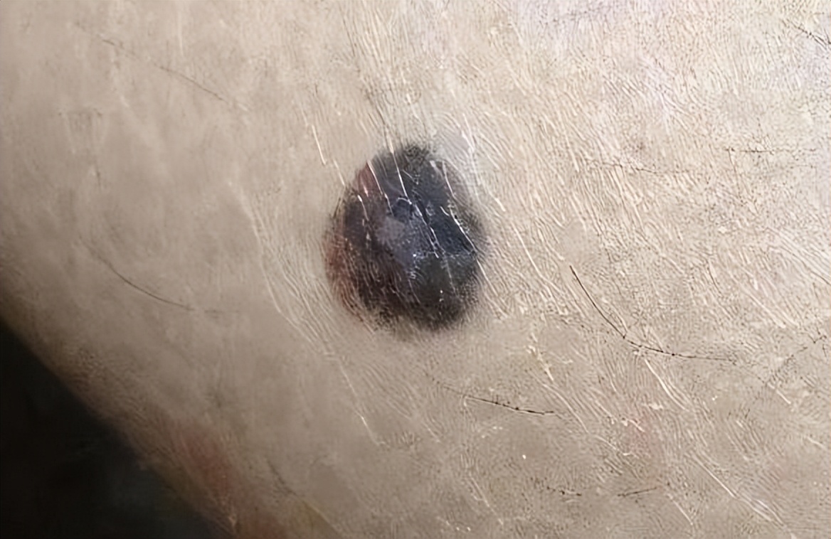 黑痣与肉痣长什么位置不能取,身上黑痣白痣红痣图片