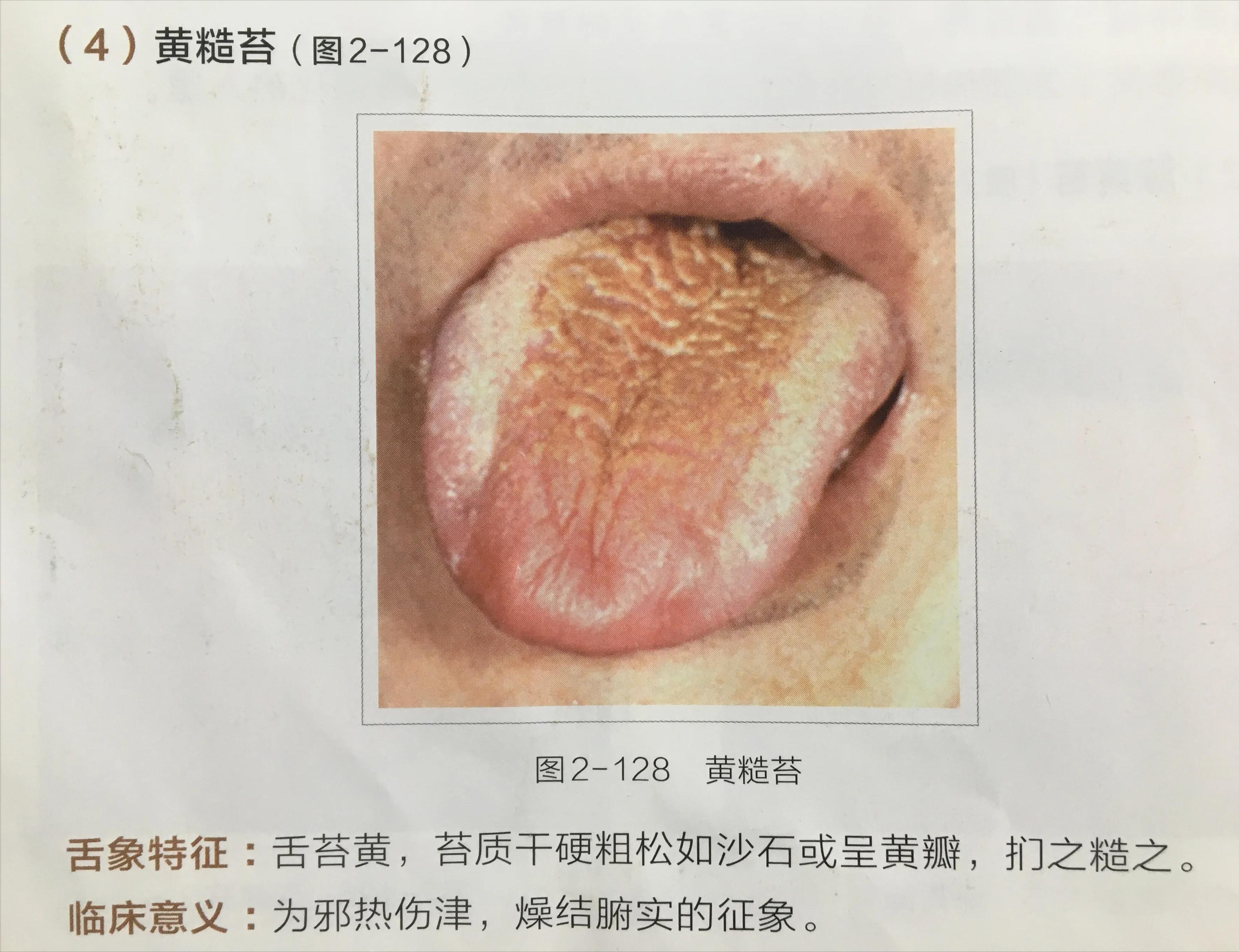 苔白舌诊与疾病对照图,舌诊中舌质红且有苔