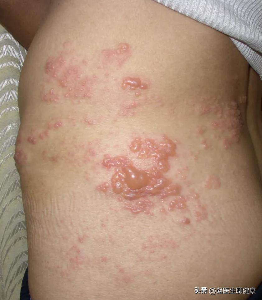 龙胆泻肝丸去肝火效果如何,龙胆泻肝丸对降肝火有用吗