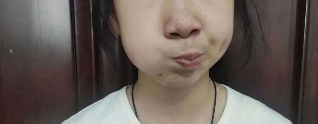 孩子嘴巴张不开发音小,小孩声带发育异常导致说话不清楚