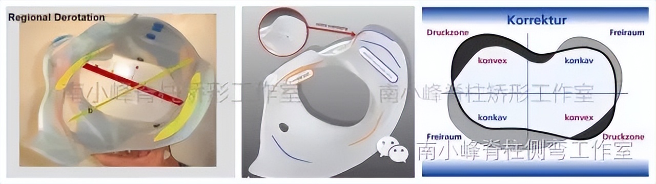 小孩脊柱侧弯恶化怎么治,脊柱侧弯多少度会形成剃刀背