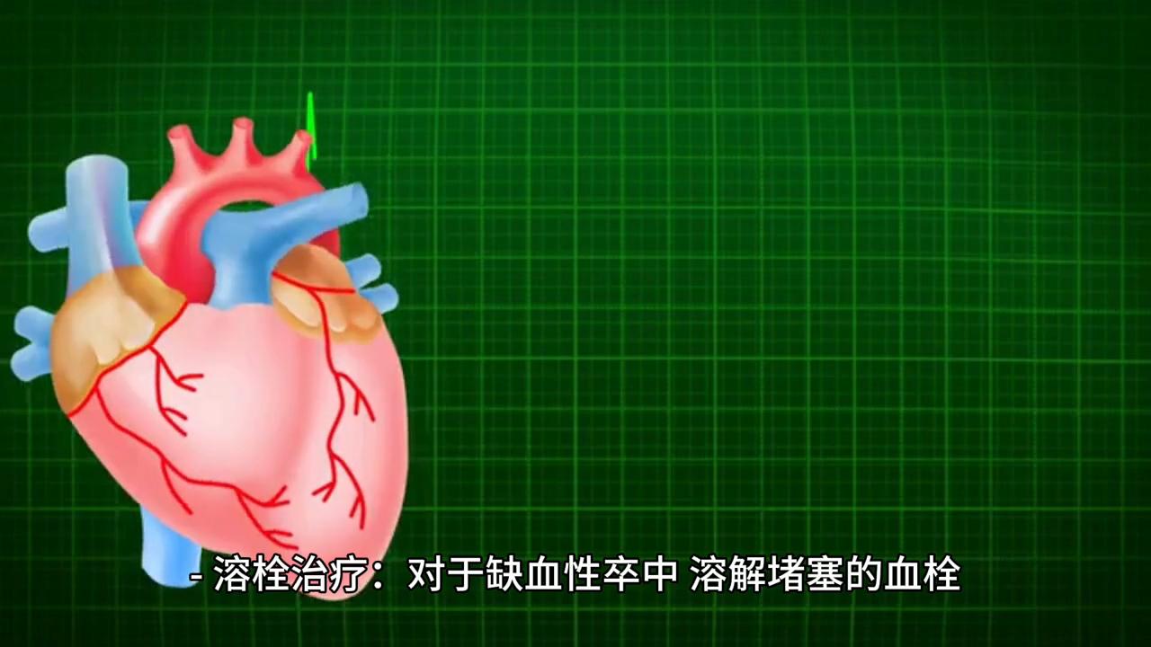 卒中治疗与预后：全面策略，重拾健康生活#卒中防控立即行动