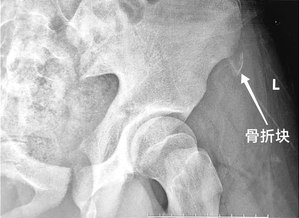 跑完步后大腿根骨头关节疼,跑完步走路大腿根部筋疼痛
