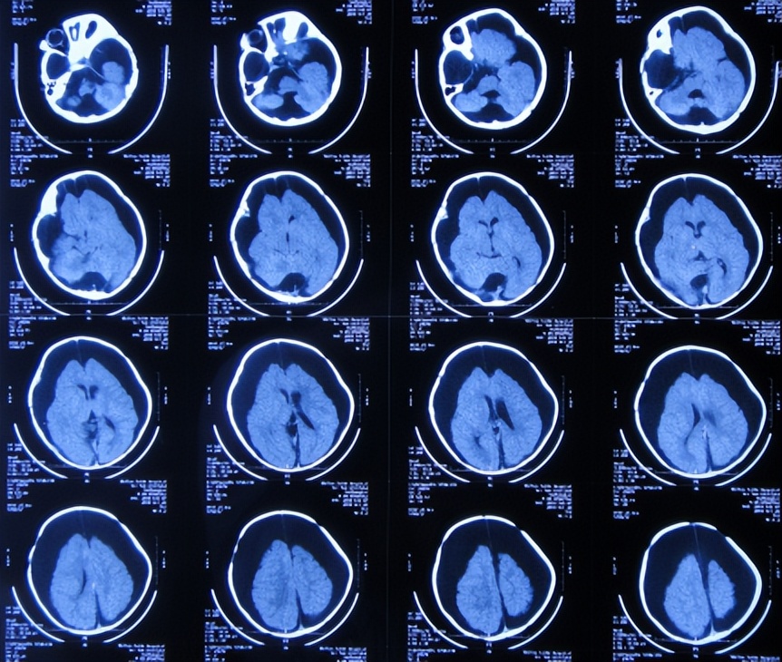 蛛网膜囊肿合并脑积水腹腔分流术,治疗蛛网膜囊肿引起脑积水严重吗
