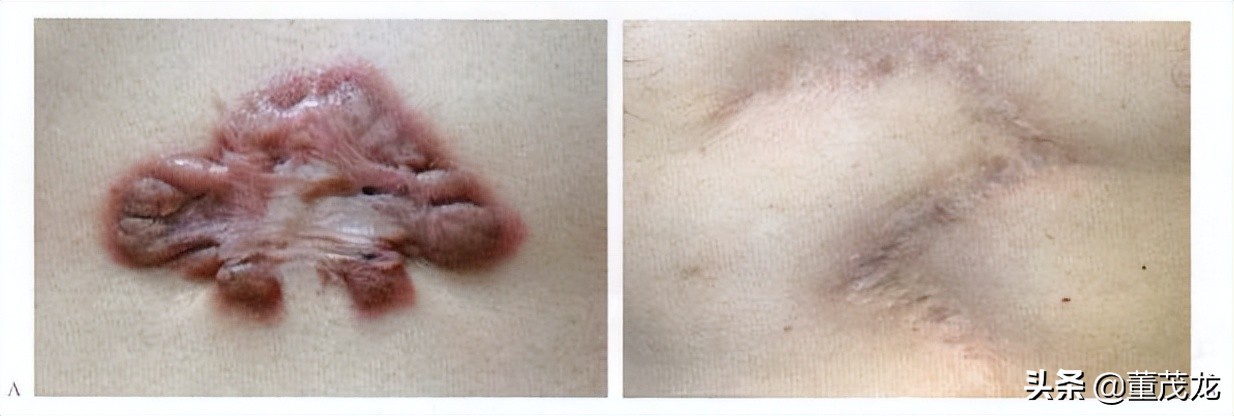 董茂龙说医:瘢痕的放射治疗