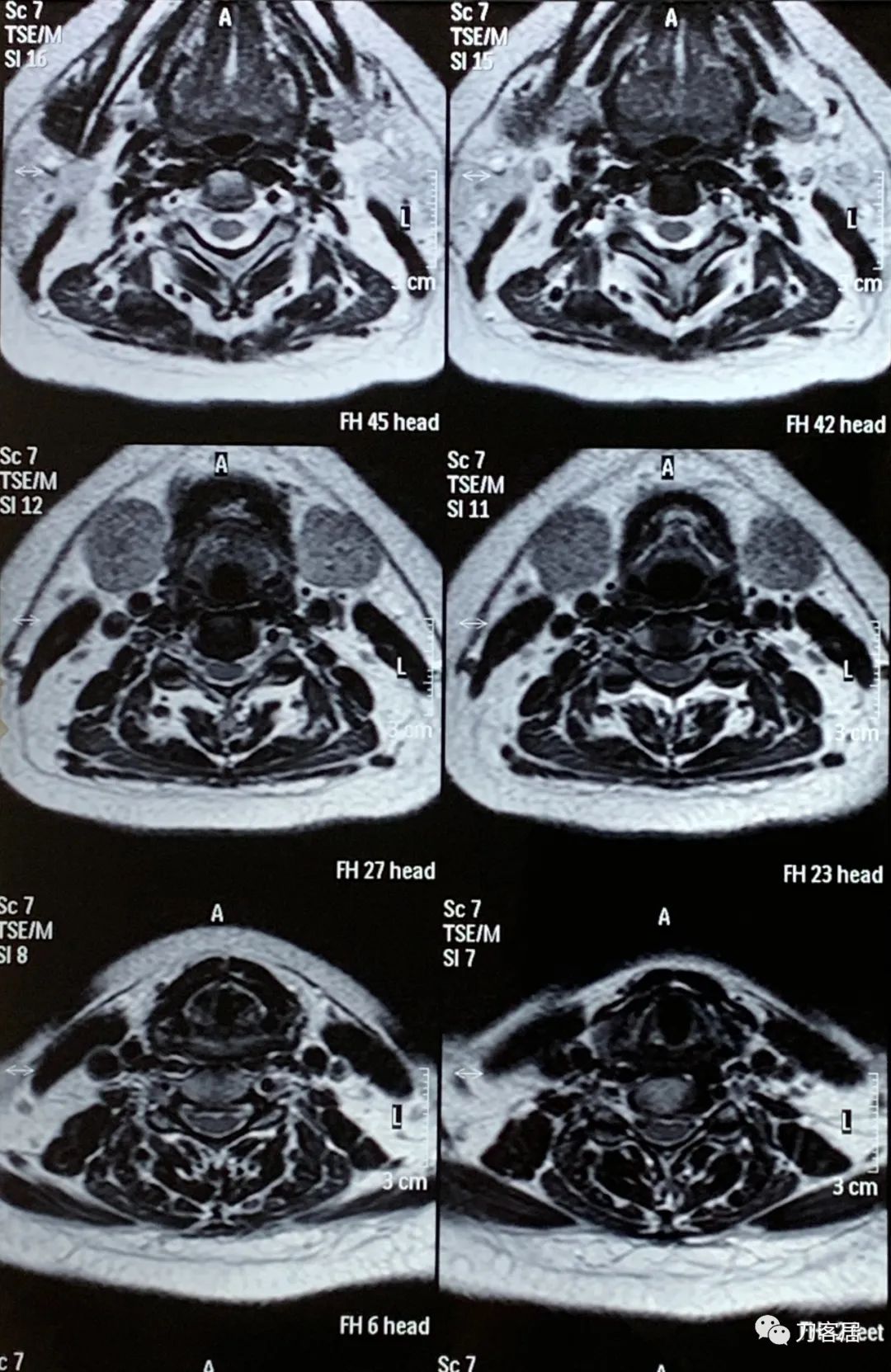 颈椎病十年了手臂酸痛肩背痛,颈椎病十年了一直痛怎么办