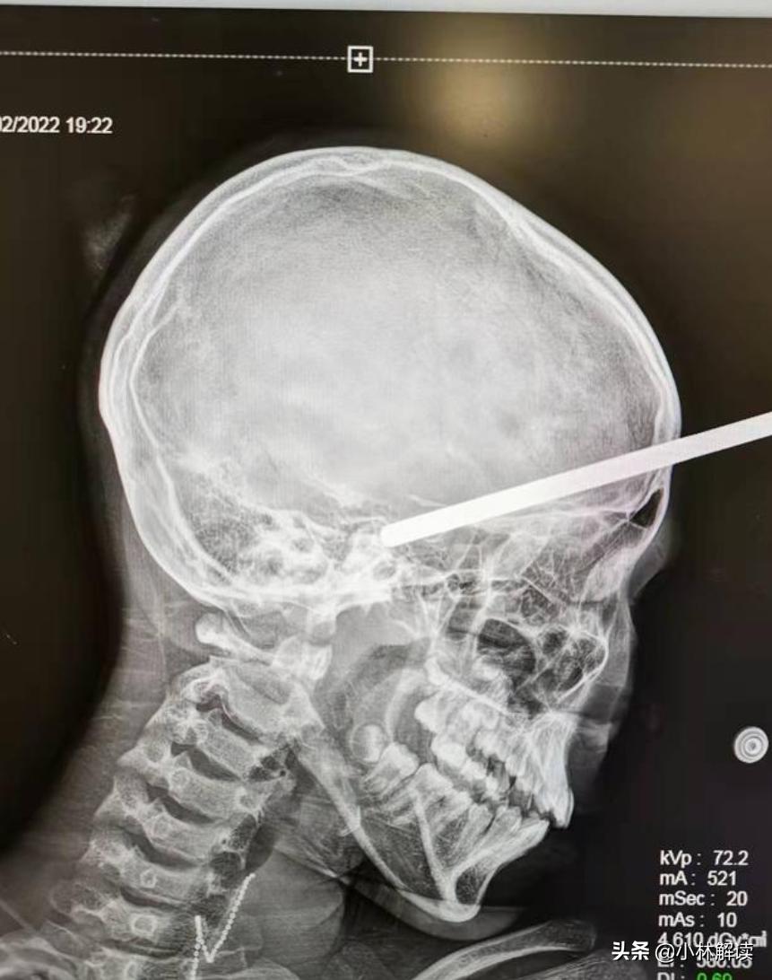孩子被木棍插入脑中抢救无效死亡,小女孩逛商场摔倒被铁棍刺入大脑