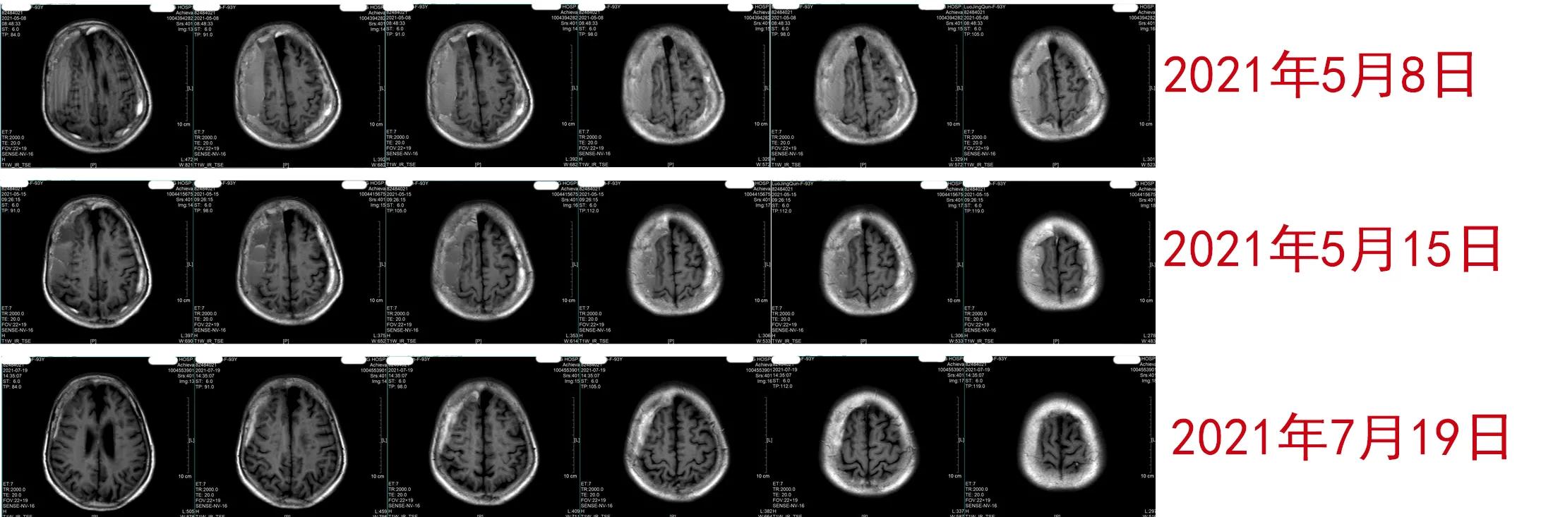 硬膜下血肿的护理诊断及措施,硬膜下血肿mr分期表现