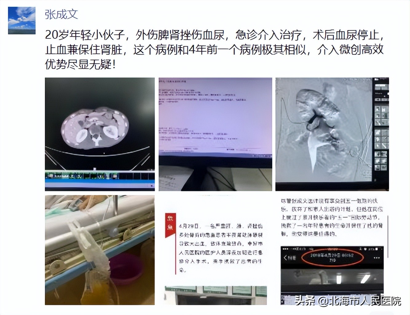 北海一20岁男子骑摩托车摔跤致脾破裂、肾挫伤、频尿血，医生为其微创止血并保住肾脏