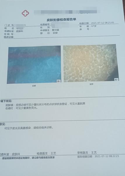 脚趾头脱皮水泡型足癣用什么药膏,足癣脚趾痒红肿怎么办