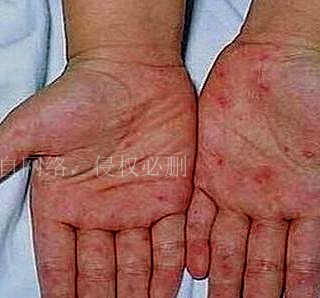 七十多岁老人检查有梅毒,七十多岁的老人家检查到梅毒