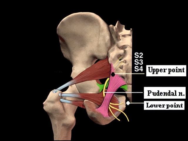 阴部神经电针刺激联合盆底肌锻炼治疗前列腺癌术后尿*禁失**