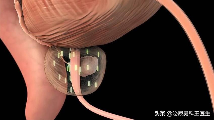 前列腺癌晚期骨转移症状有哪些,前列腺癌晚期患者临终前15个症状