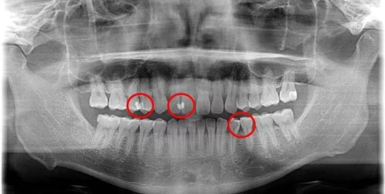 邻面龋为什么医生只补了一颗,邻面浅龋为什么医生不建议补牙