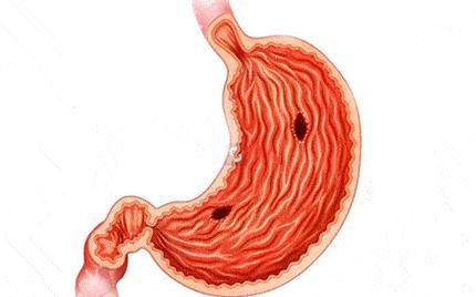 胃病怎么得来的粤语,胃病是怎么来的中医解答