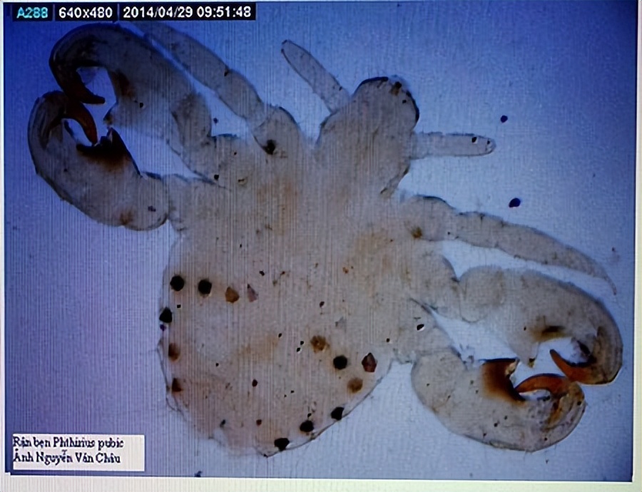 阴虱会传播性疾病吗,阴虱传播哪些疾病