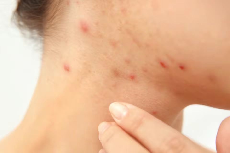 你因*疮痤**焦虑自卑？日常做好这2件事，也能拯救你的“*疮痤**脸”