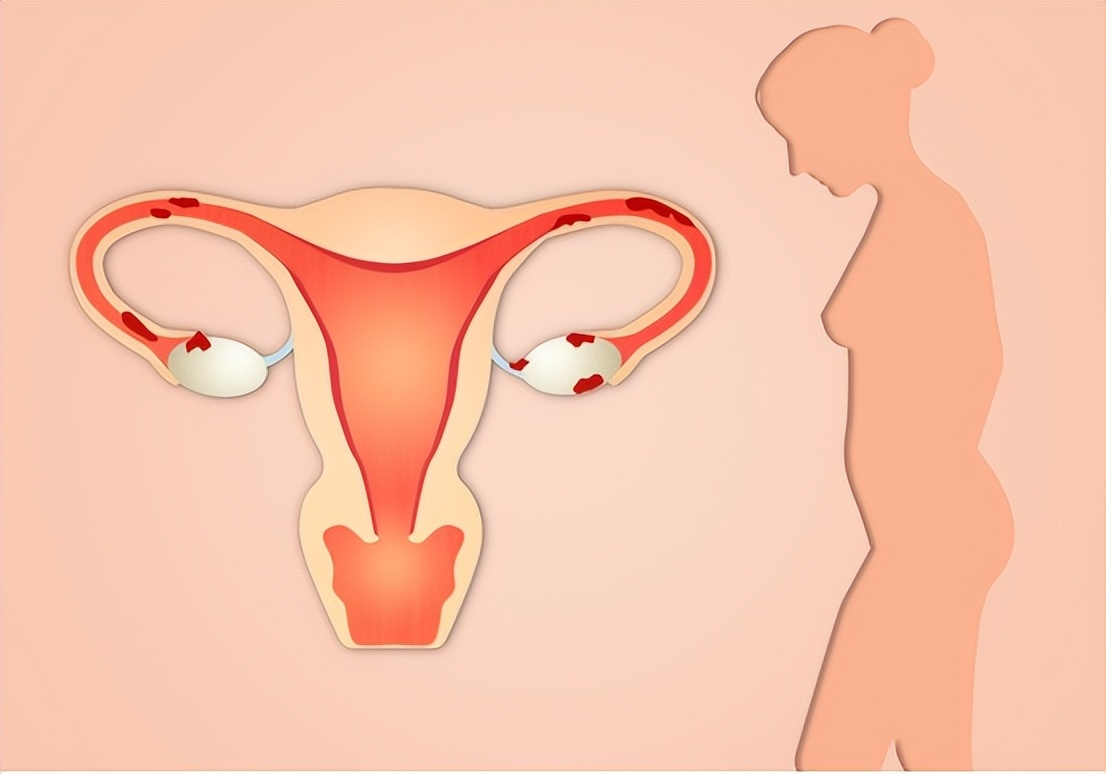 治疗尿路感染中医好还是西医好,尿路感染的原因和解决方案