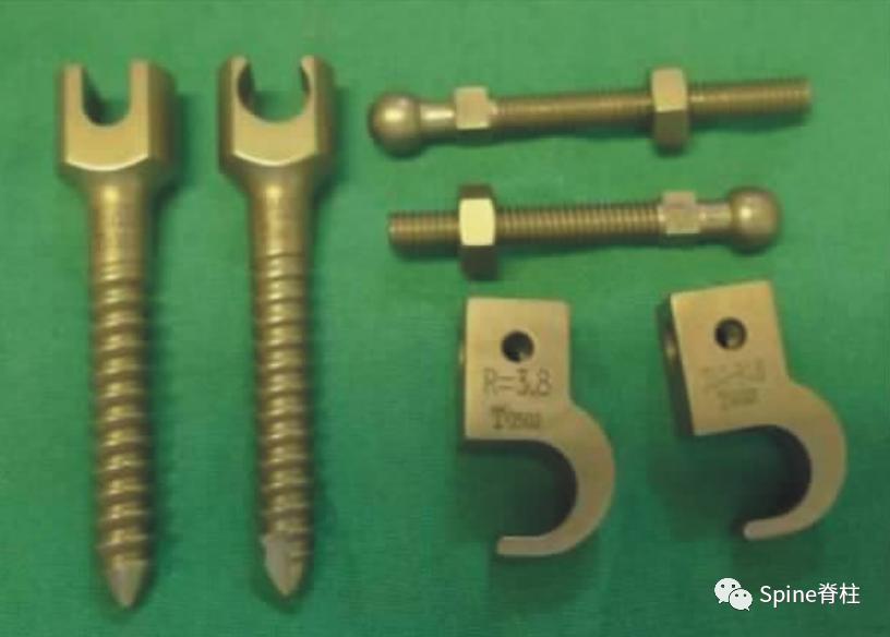 轻度峡部裂和重度峡部裂的区别,真性峡部裂和假性峡部裂