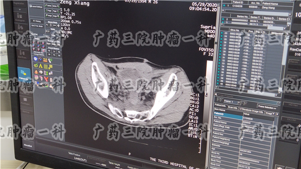 肠癌化疗后盆腔腹部出现积液,肠癌术后盆腔少量积液严重吗