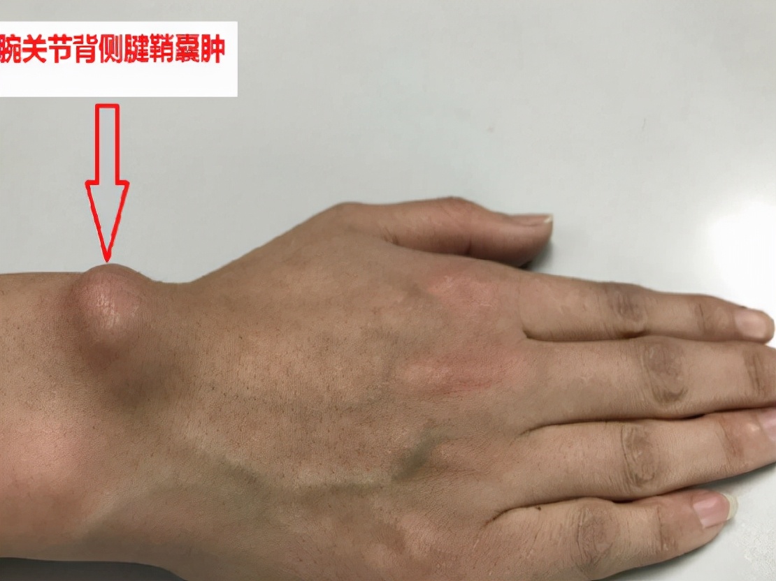 更年期女性手指腱鞘炎,女性绝经易患屈指腱鞘炎吗