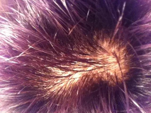 头顶漩涡处头发稀少怎么办,15岁头顶漩涡处头发稀少